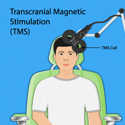 What Is Transcranial Magnetic Stimulation (TMS) and Why Is It Helpful?